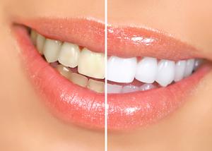 teeth whitening products