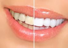teeth whitening products